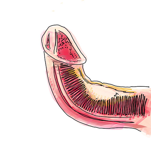 Cura dell'incurvamento del pene